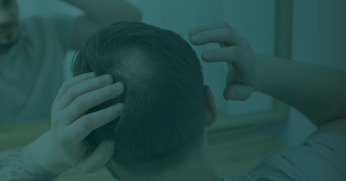 Balding crown on a man's head