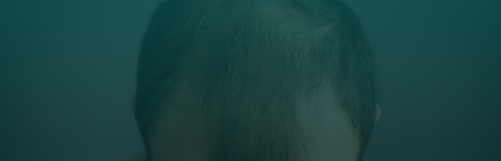 Common Causes of Hair Loss