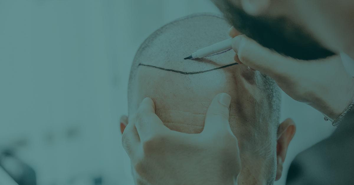 Plotting a new hairline